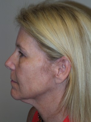 Ultherapy Before and After 02 | Grover Aesthetics