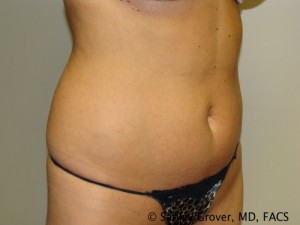 Velashape Before and After 01 | Grover Aesthetics