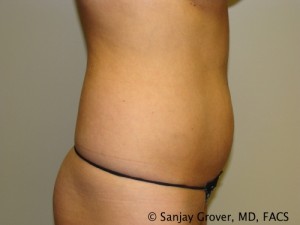 Velashape Before and After 01 | Grover Aesthetics