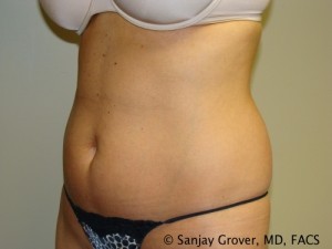 Velashape Before and After 01 | Sanjay Grover MD FACS