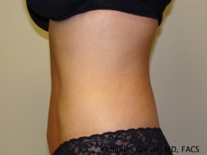 Velashape Before and After 01 | Grover Aesthetics