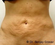 Velashape Before and After 02 | Sanjay Grover MD FACS