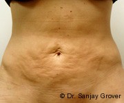 Velashape Before and After | Grover Aesthetics