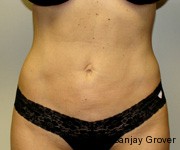 Velashape Before and After | Grover Aesthetics