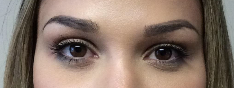 Voluma Before and After | Grover Aesthetics