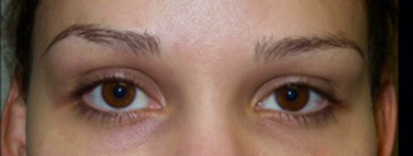 Voluma Before and After | Grover Aesthetics